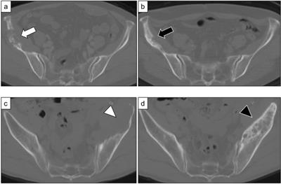 The Therapeutic Effect and Clinical Outcome of Immune Checkpoint Inhibitors on Bone Metastasis in Advanced Non-Small-Cell Lung Cancer